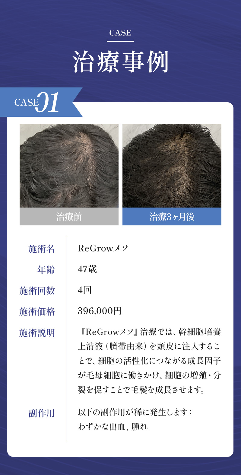治療事例ひとつ目 ReGrowメソ 47歳施術4回396,000円 『ReGrowメソ』治療では、幹細胞培養上清液（臍帯由来）を頭皮に注入することで、細胞の活性化につながる成長因子が毛母細胞に働きかけ、細胞の増殖・分裂を促すことで毛髪を成長させます。
